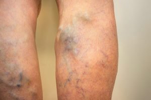 varicose veins causes and treaments