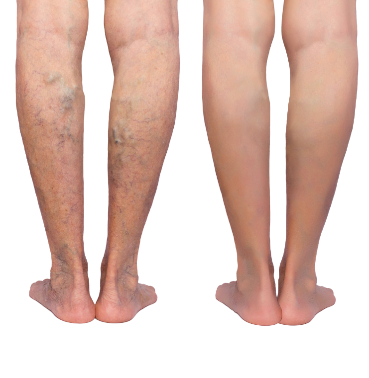 Is Varicose Vein Treatment Painful?: Center for Varicose Veins: Board  Certified Vascular and Interventional Radiologists