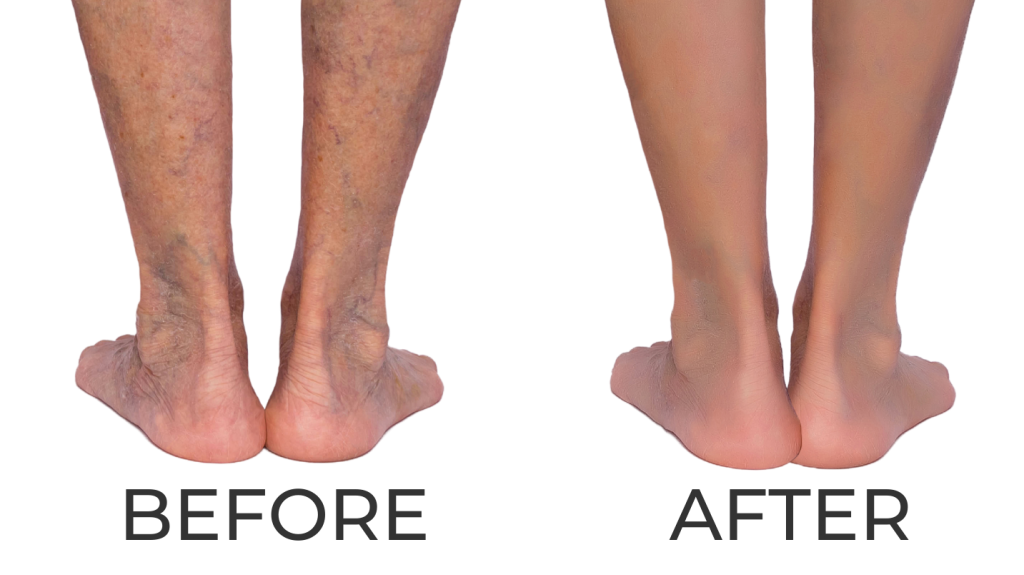 How long does it take to recover from varicose vein treatment